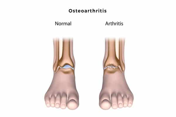 Artros i foten hälsporrekliniken