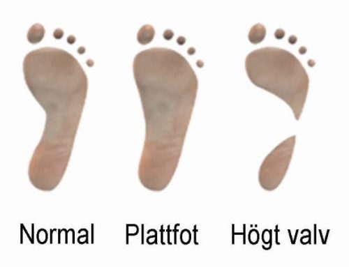 Vad är platta fötter / plattfot / pes planus?