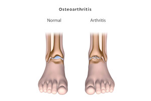 Artros i foten arthritis symptom och orsaker